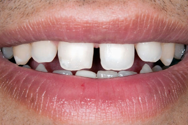 Gaps between teeth bite example